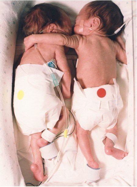 
The Rescuing Hug
This picture is from an article called “The Rescuing Hug”. The article details the first week of life of a set of twins. Each were in their respective incubators and one was not expected to live. A hospital nurse fought against the hospital rules and placed the babies in one incubator. When they were placed together, the healthier of the two, threw an arm over her sister in an endearing embrace. The smaller baby’s heart stabilized and temperature rose to normal.
source: http://piccsy.com/2011/10/the-rescuing-hug/
